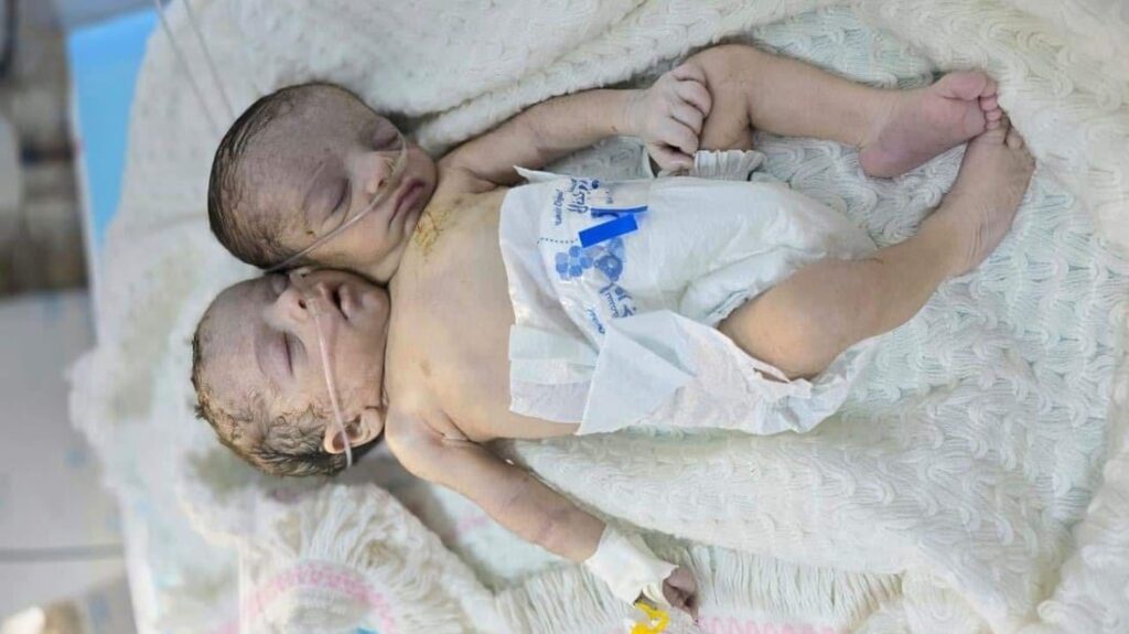 Baby with rare form of conjoined twinning born in Iraq’s Anbar governorate